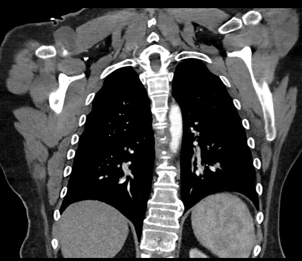 Acromioclavicular joint cyst (Radiopaedia 58455-65610 Coronal C+ arterial phase 102).jpg