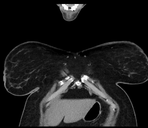 Acromioclavicular joint cyst (Radiopaedia 58455-65610 Coronal C+ arterial phase 24).jpg