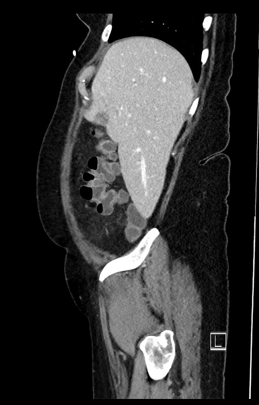 Active Crohn disease (Radiopaedia 59394-66750 Sagittal C+ portal venous phase 49).jpg