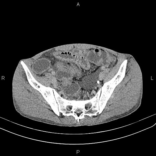 Active crohn disease (Radiopaedia 87133-103397 Axial C+ delayed 59).jpg
