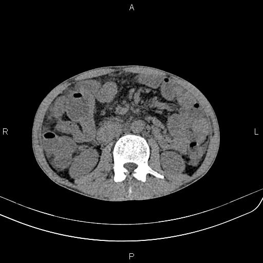 Active crohn disease (Radiopaedia 87133-103397 Axial non-contrast 48).jpg