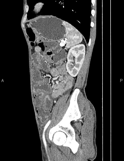 Active crohn disease (Radiopaedia 87133-103397 Sagittal C+ arterial phase 67).jpg