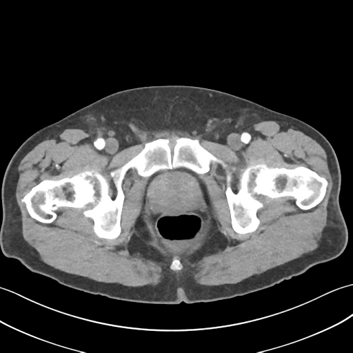 File:Active diverticular hemorrhage (Radiopaedia 39415-41725 Axial C+ arterial phase 71).png