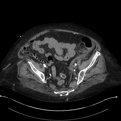 Active renal extravasation with large subcapsular and retroperitoneal hemorrhage (Radiopaedia 60975-68796 Axial C+ arterial phase 156).jpg