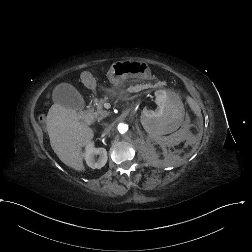 Active renal extravasation with large subcapsular and retroperitoneal hemorrhage (Radiopaedia 60975-68796 Axial C+ arterial phase 73).jpg