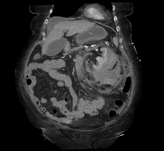 Active renal extravasation with large subcapsular and retroperitoneal hemorrhage (Radiopaedia 60975-68796 Coronal C+ arterial phase 52).jpg