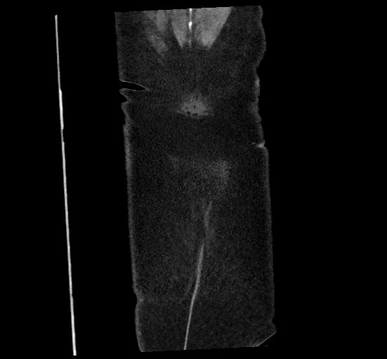 Active renal extravasation with large subcapsular and retroperitoneal hemorrhage (Radiopaedia 60975-68796 Coronal C+ portal venous phase 147).jpg