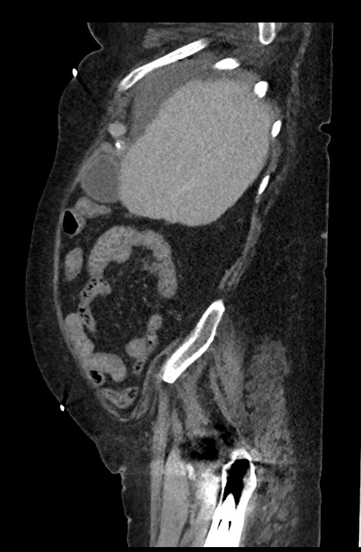 Active renal extravasation with large subcapsular and retroperitoneal hemorrhage (Radiopaedia 60975-68796 Sagittal C+ portal venous phase 176).jpg