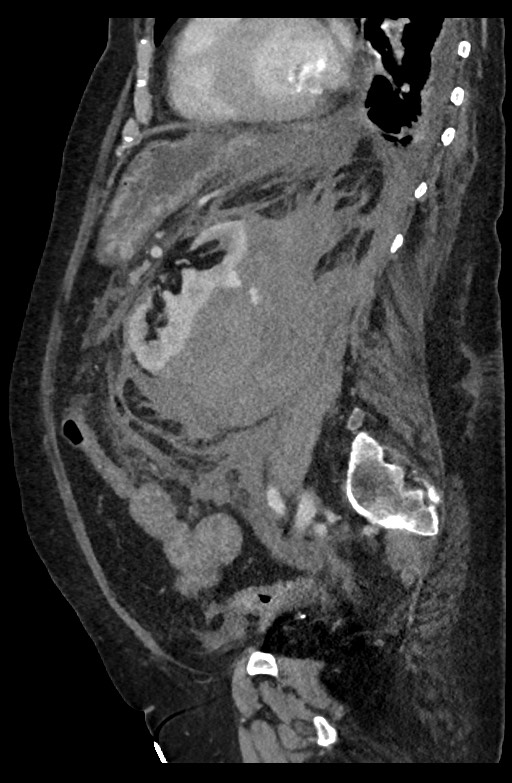 Active renal extravasation with large subcapsular and retroperitoneal hemorrhage (Radiopaedia 60975-68796 Sagittal C+ portal venous phase 93).jpg