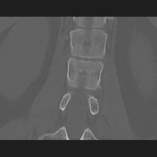 File:Acute L1 burst compression fracture (Radiopaedia 34430-35755 Axial bone window 1).png