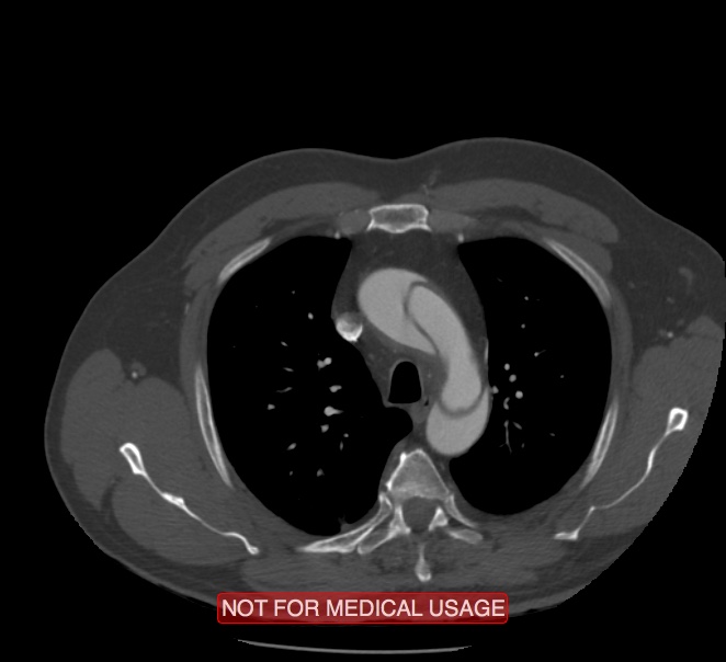 Acute aortic dissection - Stanford type A (Radiopaedia 40661-43285 Axial C+ arterial phase 9).jpg