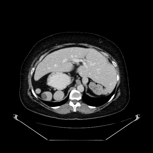 File:Acute appendicitis, heterotaxy syndrome (Radiopaedia 66884-76202 Axial 91).jpg