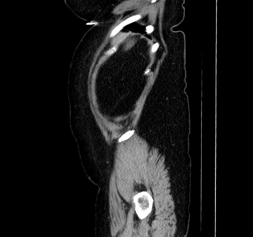 Acute appendicitis, heterotaxy syndrome (Radiopaedia 66884-76202 Sagittal C+ portal venous phase 24).jpg