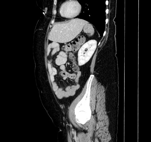Acute appendicitis, heterotaxy syndrome (Radiopaedia 66884-76202 Sagittal C+ portal venous phase 97).jpg