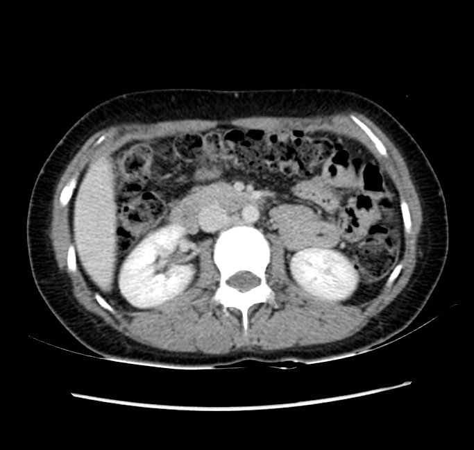 Acute appendicitis (Radiopaedia 22892-22918 Axial C+ portal venous phase 33).png