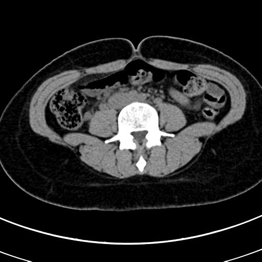 Acute appendicitis (Radiopaedia 30261-30888 Axial non-contrast 48).jpg