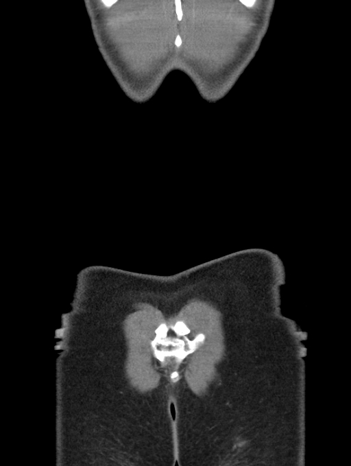 Acute appendicitis (Radiopaedia 62608-70901 Coronal C+ portal venous phase 65).jpg