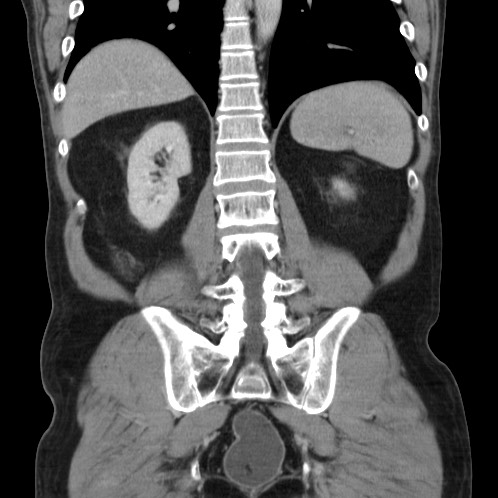 Acute appendicitis (Radiopaedia 66513-75790 Coronal C+ portal venous phase 65).jpg