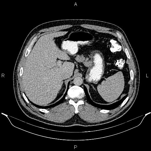Acute appendicitis (Radiopaedia 84780-100240 Axial C+ portal venous phase 25).jpg