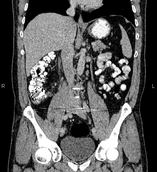 Acute appendicitis (Radiopaedia 84780-100240 Coronal C+ portal venous phase 42).jpg