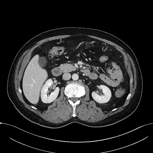 File:Acute appendicitis - large appendicoliths (Radiopaedia 61805-69820 Axial 57).jpg