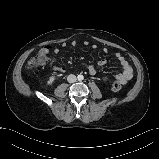 File:Acute appendicitis - large appendicoliths (Radiopaedia 61805-69820 Axial C+ portal venous phase 73).jpg