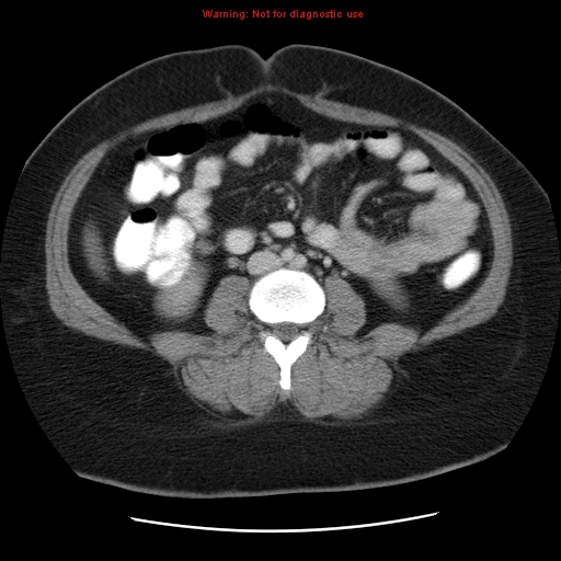 Acute appendicitis complicated by ovarian vein thrombophlebitis (Radiopaedia 16172-15851 Axial C+ portal venous phase 53).jpg