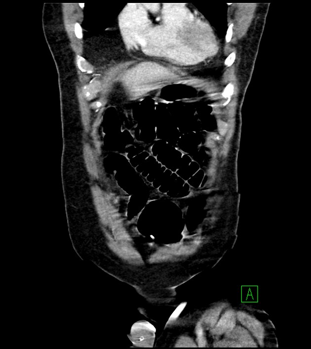 Acute arterial mesenteric ischemia (Radiopaedia 78238-90828 Coronal C+ portal venous phase 23).jpg
