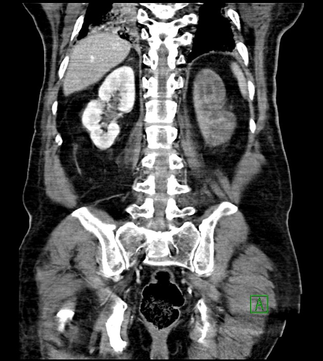 Acute arterial mesenteric ischemia (Radiopaedia 78238-90828 Coronal C+ portal venous phase 69).jpg