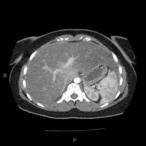Acute bilateral pyelonephritis (Radiopaedia 37146-38881 Axial C+ arterial phase 35).jpg