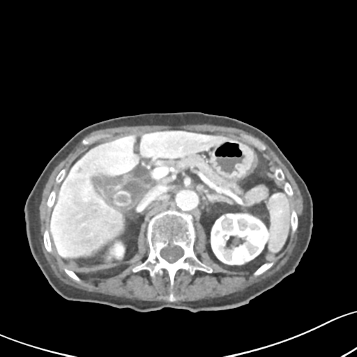 Acute cholecystitis with contained perforation (Radiopaedia 47328-51907 Axial C+ portal venous phase 24).png