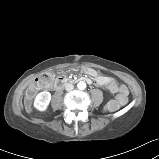 Acute cholecystitis with contained perforation (Radiopaedia 47328-51907 Axial C+ portal venous phase 40).png