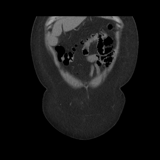File:Acute cholecystitis with tensile fundus sign (Radiopaedia 71394-81723 Coronal 103).jpg
