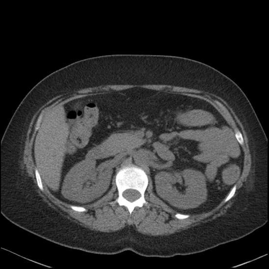 Acute colonic hemorrhage in ulcerative colitis (Radiopaedia 77415-89538 Axial non-contrast 48).jpg