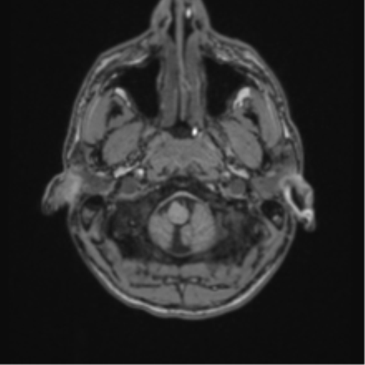 Acute disseminated encephalomyelitis (ADEM) (Radiopaedia 65319-74349 Axial T1 1).png