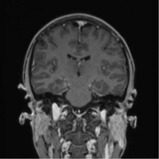 Acute disseminated encephalomyelitis (ADEM) (Radiopaedia 65319-74349 Coronal T1 C+ 20).png