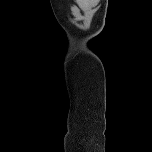 Acute diverticulitis with localized perforation (Radiopaedia 41296-44113 Sagittal C+ portal venous phase 77).jpg