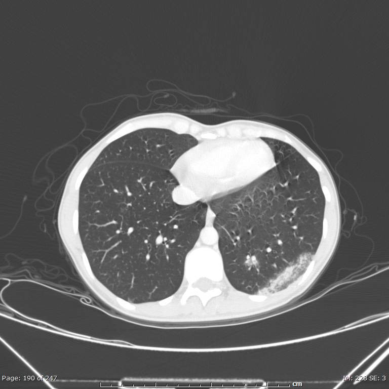 Acute eosinophilic pneumonia (Radiopaedia 48211-53073 Axial lung window 68).jpg