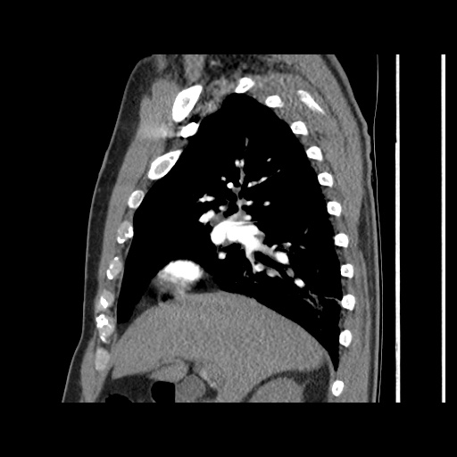 Acute epicardial fat necrosis (Radiopaedia 42327-45440 Sagittal C+ CTPA 27).jpg