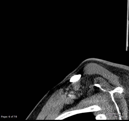 Acute epiglottitis (Radiopaedia 54375-60590 Sagittal C+ arterial phase 6).jpg