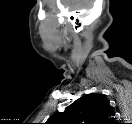 Acute epiglottitis (Radiopaedia 54375-60590 Sagittal C+ arterial phase 60).jpg