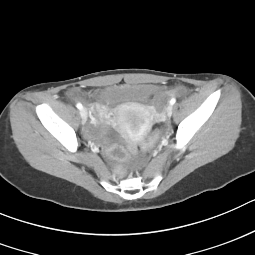 Acute gangrenous appendicitis with perforation (Radiopaedia 40152-42662 Axial C+ portal venous phase 62).png