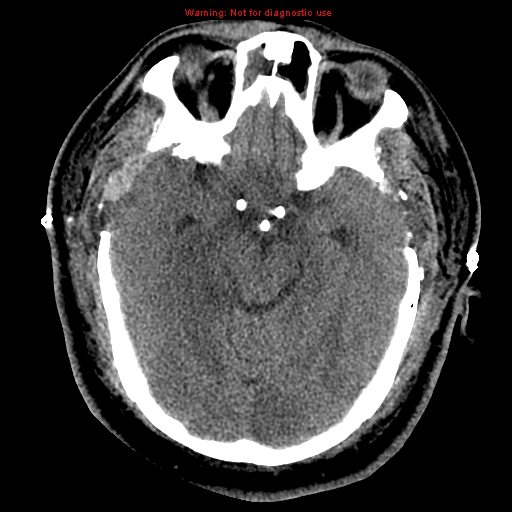 Acute hemorrhagic leukoencephalitis (Radiopaedia 14076-43697 Axial non-contrast 18).jpg