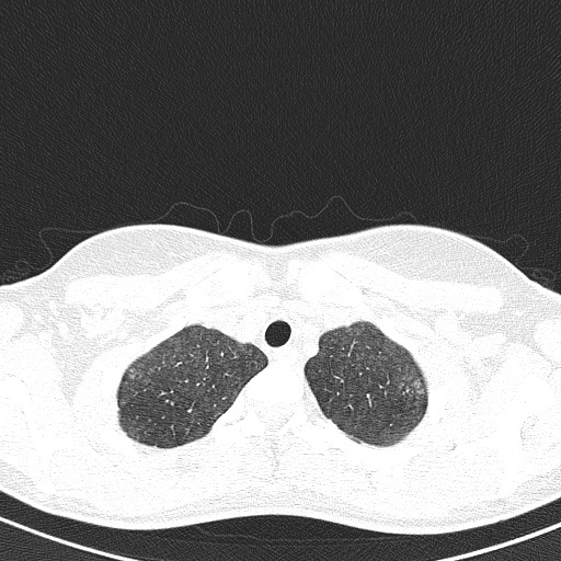 File:Acute hypersensitivity pneumonitis (Radiopaedia 85293-100870 Axial lung window 12).jpg