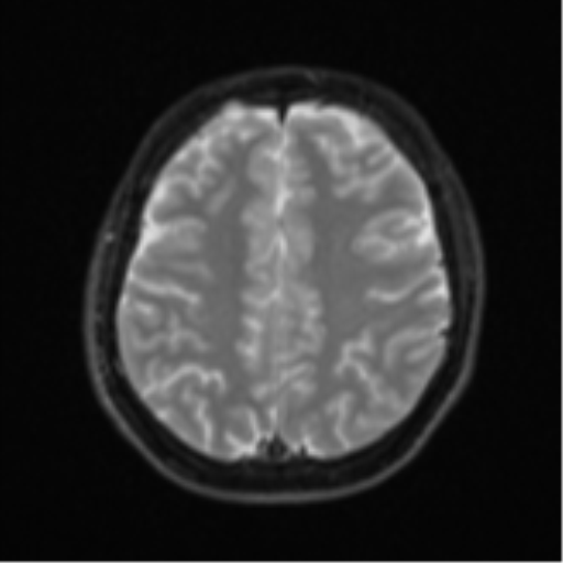 Acute left middle cerebral artery territory infarct with clot retrieval (Radiopaedia 47732-52433 Axial DWI 22).png