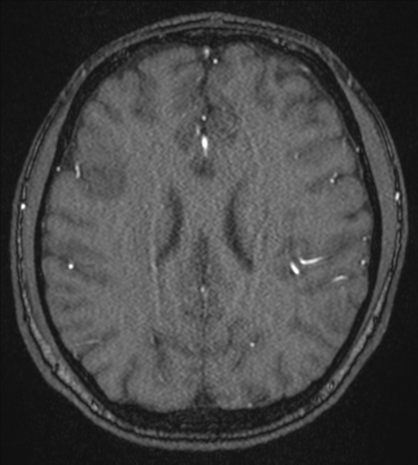 Acute left middle cerebral artery territory infarct with clot retrieval (Radiopaedia 47732-52433 Axial MRA 42).png