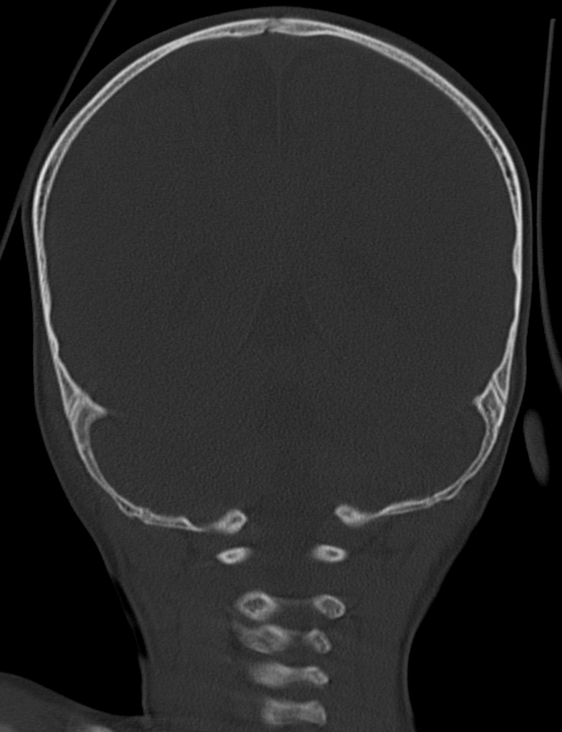 Acute mastoiditis (Radiopaedia 82678-96881 Coronal bone window 55).jpg
