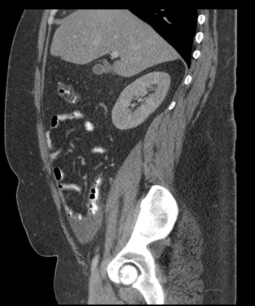 Acute mesenteric venous ischemia (Radiopaedia 46041-50383 Sagittal C+ portal venous phase 37).jpg