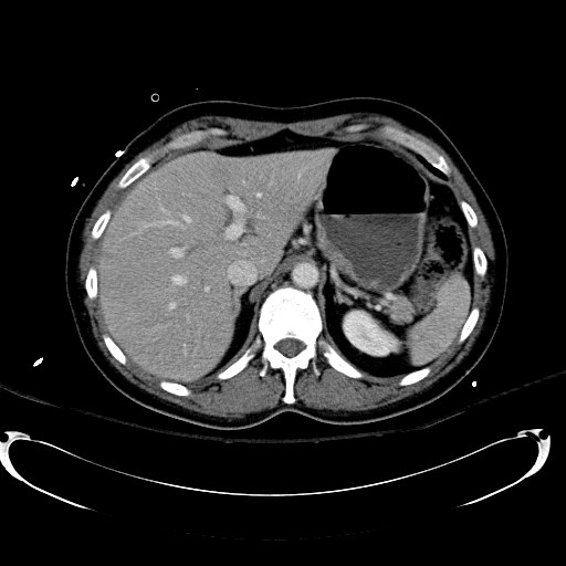 Acute myocardial infarction in CT (Radiopaedia 39947-42415 Axial C+ portal venous phase 31).jpg