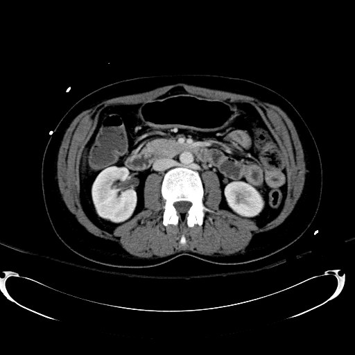 File:Acute myocardial infarction in CT (Radiopaedia 39947-42415 Axial C+ portal venous phase 59).jpg